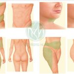 Tìm hiểu hút mỡ bụng không phẫu thuật Cavi Deluxe