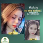 Bác sĩ nào làm thu nhỏ đầu mũi không cần phẫu thuật?