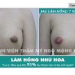 Làm sao để nhũ hoa trắng hồng?