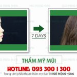 Tuổi dậy thì nâng mũi có hại không?