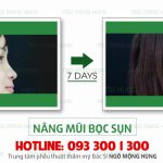 Phẩu thuật nâng mũi Hàn Quốc có vĩnh viễn không?