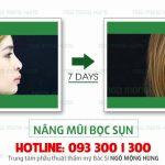 Nâng mũi bọc sụn có tốt không giá bao nhiêu?