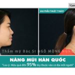 Thu gọn cánh mũi bằng cách cuộn bên trong giá bao nhiêu?
