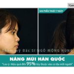 Giá tiền nâng mũi Hàn Quốc ở Sài Gòn bao nhiêu?