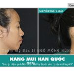 Serum nâng mũi hàn quốc có tốt không giá bao nhiêu?
