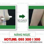 Giá phẫu thuật nâng ngực chảy xệ hết bao nhiêu?