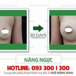 Có nên nâng ngực chảy xệ không? Bv NMH
