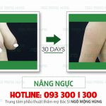 Giải phẫu thẩm mỹ nâng ngực chảy xệ chi phí bao nhiêu?