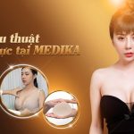 Hỏi nhiều về giá nâng ngực và ở đâu rẻ và đẹp