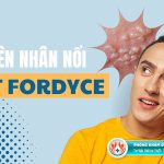 Thông tin chi tiết về hạt Fordyce ở bao quy đầu