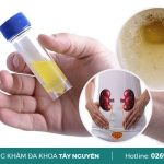 Nước Tiểu Có Bọt Là Dấu Hiệu Bệnh Gì?