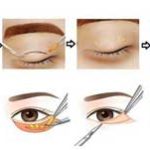 Địa chỉ cắt mí mắt ở đâu đẹp nhất SG