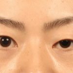 Sụp mí mắt là như thế nào? Có điều trị được không?