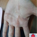 Tay nổi mụn nước là bệnh gì?