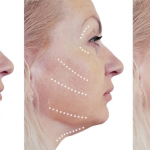 Sức khỏe, đời sống: Căng Da Mặt – Giải Pháp Trẻ Hóa Làn Da Hiệu Quả