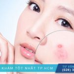 Giải Mã: Vị Trí Nổi Mụn Trên Khuôn Mặt Nói Lên Điều Gì?