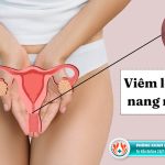 Nơi điều trị nang Naboth ở TPHCM uy tín bạn nên biết