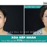 Xóa nếp nhăn bằng tia laze có hiệu quả hay không