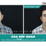 Xóa hết nếp nhăn nhanh nhất bằng cách nào