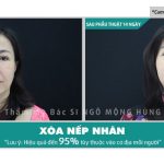Xóa nếp nhăn bằng thermage