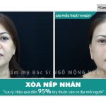 Xóa nếp nhăn ở mắt bằng dầu dừa có nên không