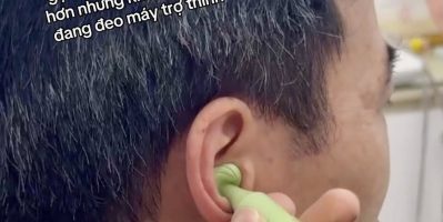 10 năm chịu đựng nghe kém để đi tìm một giải pháp đủ nhỏ gọn, đủ thẩm mỹ, đủ kín đáo